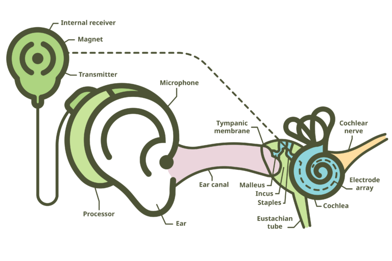 Cochlear Implants: From Fundamentals to Clinical Mastery